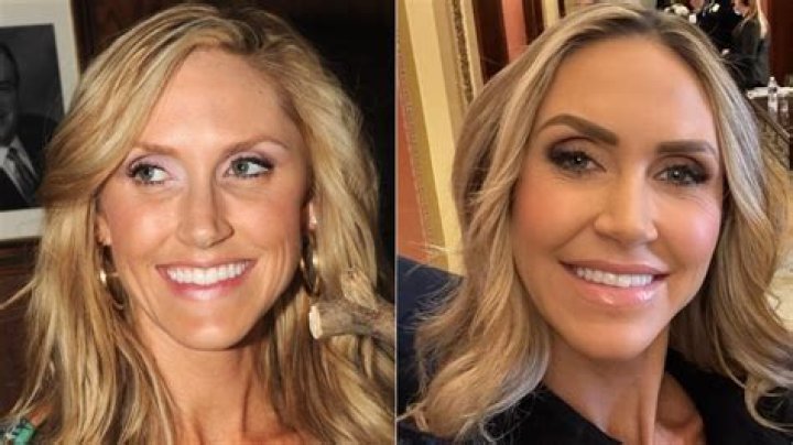 Lara Trump Plastic Surgery Before and After Transformation: The Full Story You Need to Know